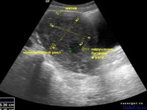 Узи органов малого таза у женщин когда лучше делать при миоме матки
