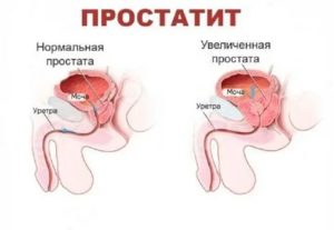 Простатит это страшный диагноз или нет