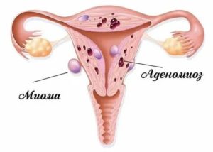 Норколут отзывы при эндометриозе и миоме матки