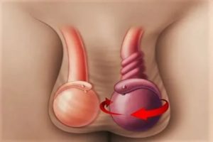 Может ли быть перекрут яичка если уже была такая операция