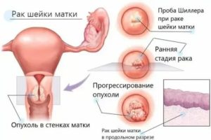 Можно ли заразиться раком шейки матки через общего партнера