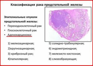 Тромбоэмболия при раке предстательной железы