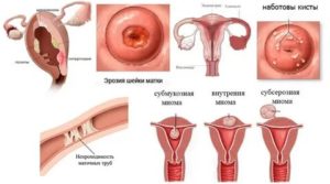 Что такое единичные кисты эндоцервикса в шейке матки