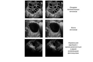 Что такое мультикистозные яичники и как это лечить