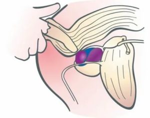 Пальпация простаты техника выполнения