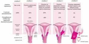 Что такое нулевая стадия рака шейки матки