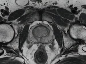 Мрт омт предстательной железы с контрастированием как готовиться к нему