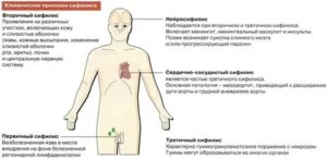 Что такое сифилис и как он проявляется у мужчин