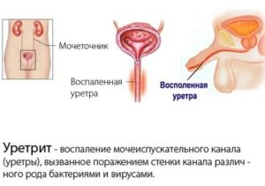 Как лечить негонококкового уретрита