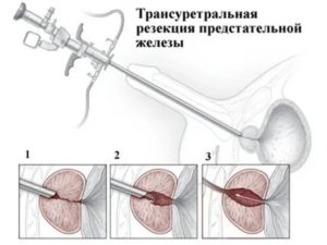 Трансуретральная резекция предстательной железы отзывы