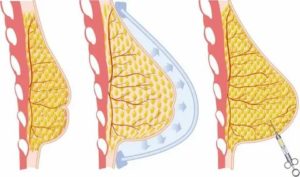 Как называется операция по увеличению молочных желез