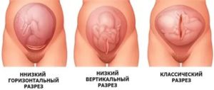 Причины бесплодия после кесарева сечения