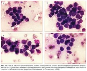 Цитологическая картина карциномы молочной железы