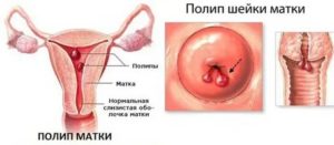 Какие месячные при полипе шейки матки