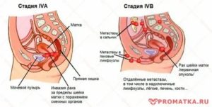 Сколько живут при раке матки 4 степени с метастазами