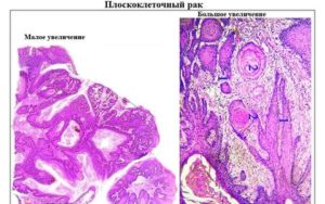 Что такое умеренно-дифференцируемый плоскоклеточный рак шейки матки