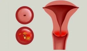 Воспаление цервикального канала при климаксе