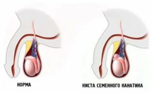 Что такое киста придатка правого яичка у мужчин