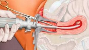 Как делают вакуумную операцию в гинекологии