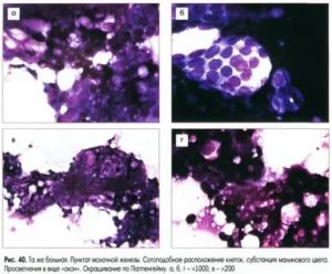 Что такое цитология при раке молочной железы