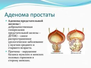 Заболевание предстательной железы у мужчин причины заболевания