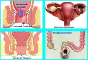 Что такое если во время месячных болит задний проход