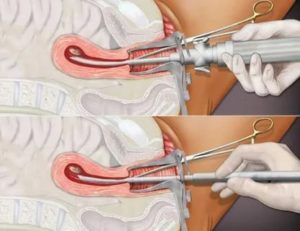 Как делают вакуумную операцию в гинекологии