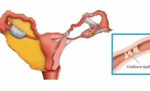 Как определить спайки в маточных трубах без операции