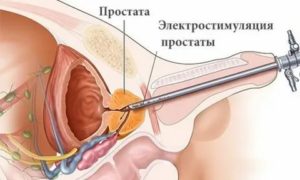 Стимуляция простаты через уретру