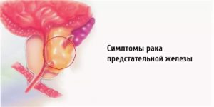 Сокотерапия при раке простаты
