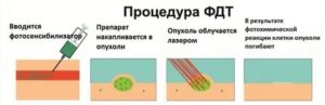 Фотодинамическая терапия при лечении рака шейки матки