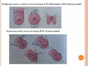 Как проходит операция по наложению шва на шейку матки