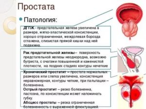 Мфб предстательной железы что это такое