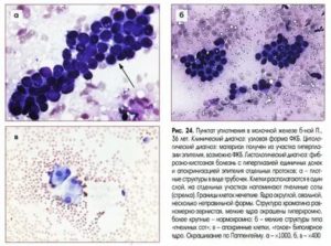 Что такое цитология при раке молочной железы