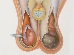 Что такое киста придатка правого яичка у мужчин