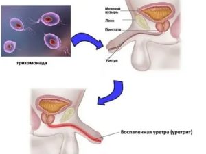 Лечение хронического трихомонадного простатита