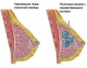 Могут ли перед месячными появляться уплотнения на груди