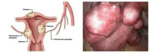 Может ли фиброма матки перейти в рак
