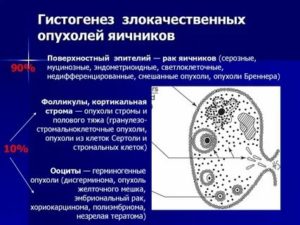 Злокачественные опухоли яичника презентация