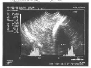 Узи биометрия шейки матки при беременности