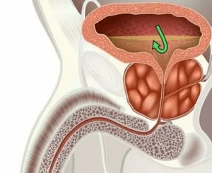 Мне 23 года у меня хронический простатит