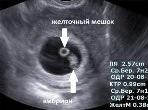 Видно плодное яйцо на узи не видно эмбрион и желтое тело