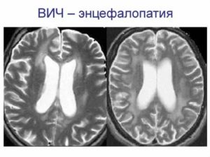 Как лечить энцефалопатию головного мозга при вич