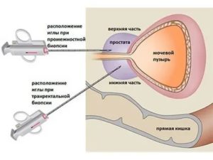 Осложнения после биопсии предстательной железы отзывы