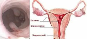 Как часто полип в матке перерождается в рак