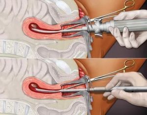 Антибиотики после выскабливания полости матки окситоцин