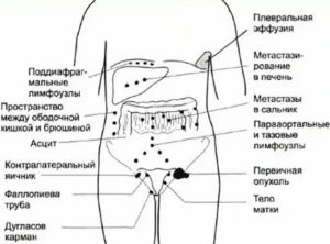 Куда могут пойти метастазы при раке яичников