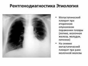 Плеврит легких при раке молочной железы прогноз