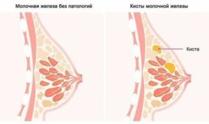 Могут ли перед месячными появляться уплотнения на груди