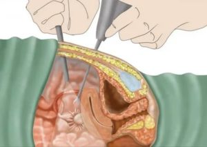Как делают операцию по удалению фибромы матки